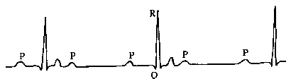 АВ-блокада II степени на ЭКГ (III тип)